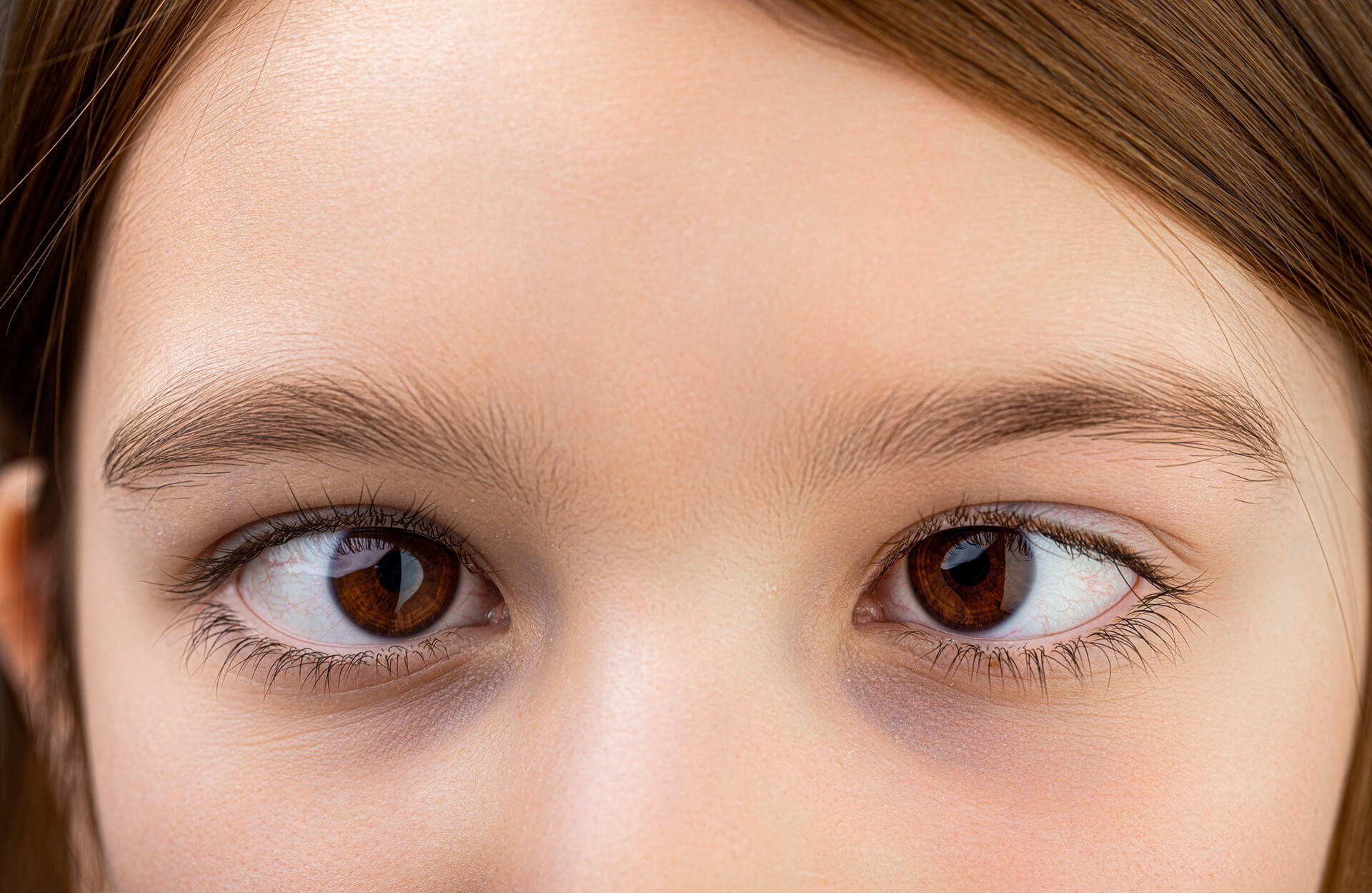 Kid With Strabismus